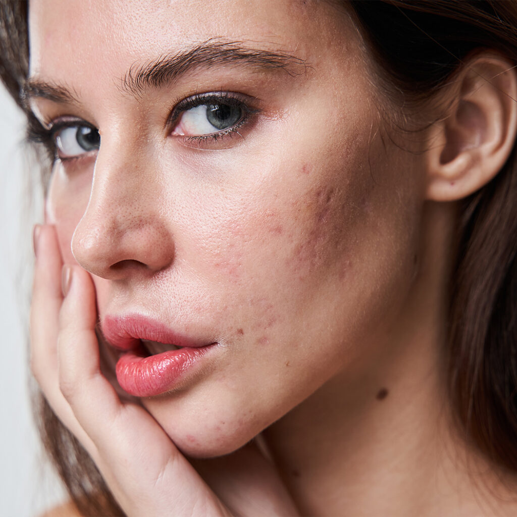 Photo of a brunette woman touching her face. She has acne and acne scars on her cheek.