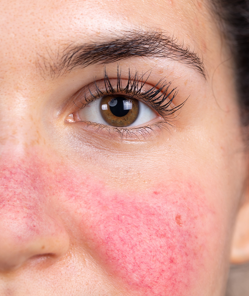 Close-up photo of rosacea on a brown-eyed woman's face