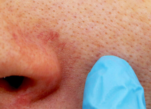 Photo of facial veins near a man's nose