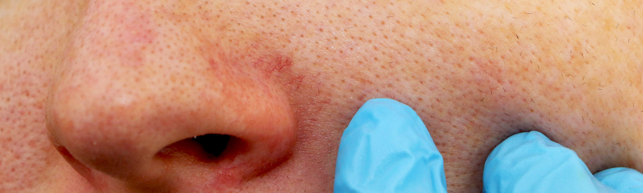 Facial Veins