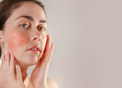 Photo a woman with rosacea touching her face